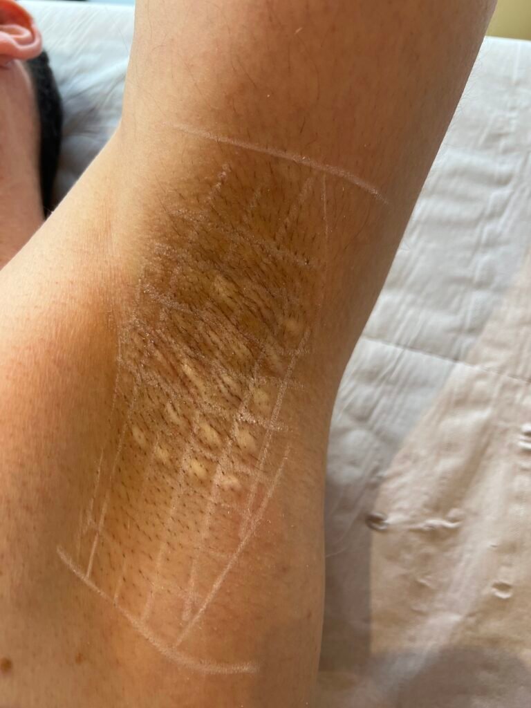 Dr Damien Godart botox transpiration - médecine esthétique