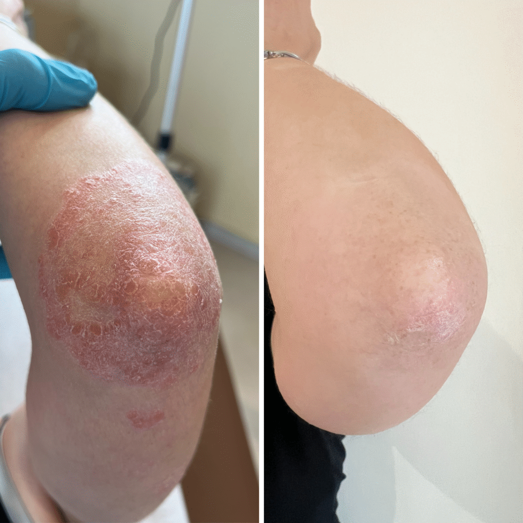 Dr Damien Godart - médecine régénérative - PRP Psoriasis